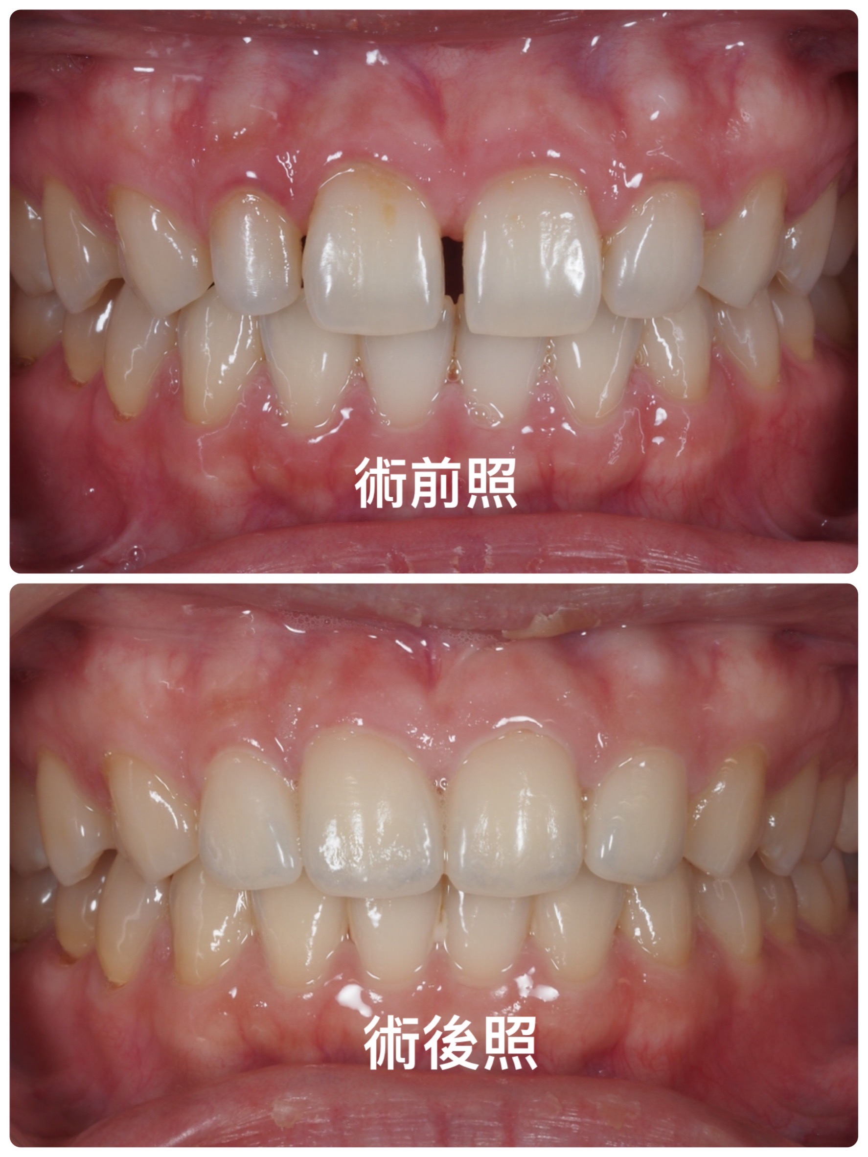 陶瓷貼片案例